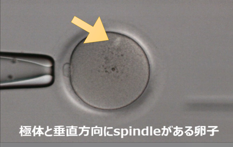 紡錘体が極体と垂直方向にある卵子